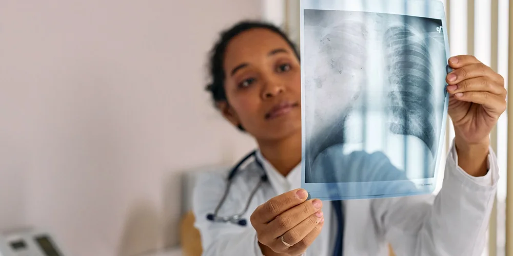 Pulmoner Emboli (Akciğer Embolisi): Bacaktaki Pıhtının En Tehlikeli Sonucu